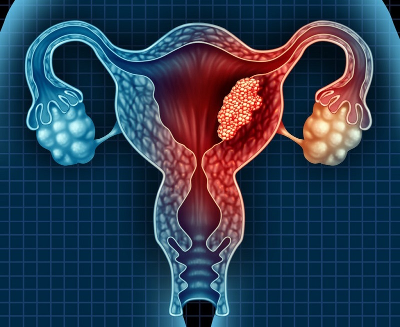 Endometrium Rahim Kanseri